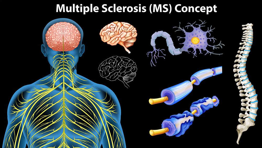 Multiple Sclerosis Can Negatively Affect Your Lung Function
