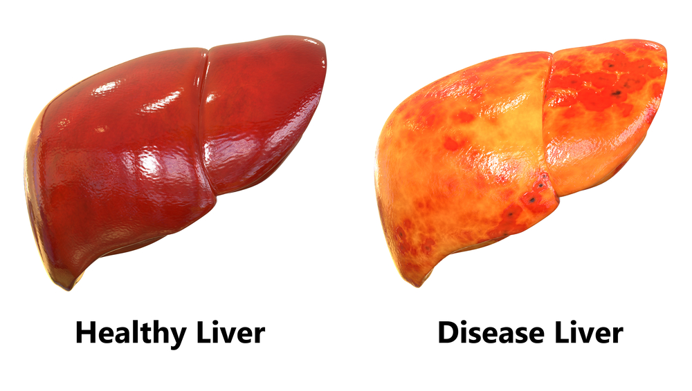 Know the Essential Facts about Your Liver