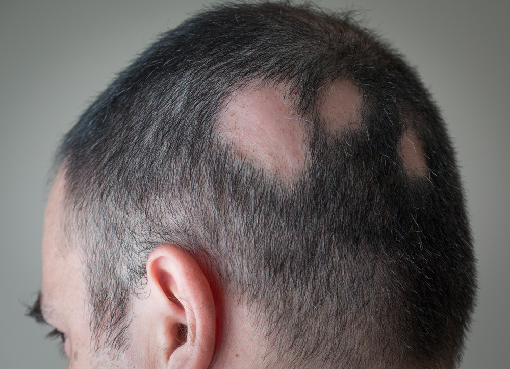 What is Alopecia Areata? Can this type of Hair Loss be treated?
