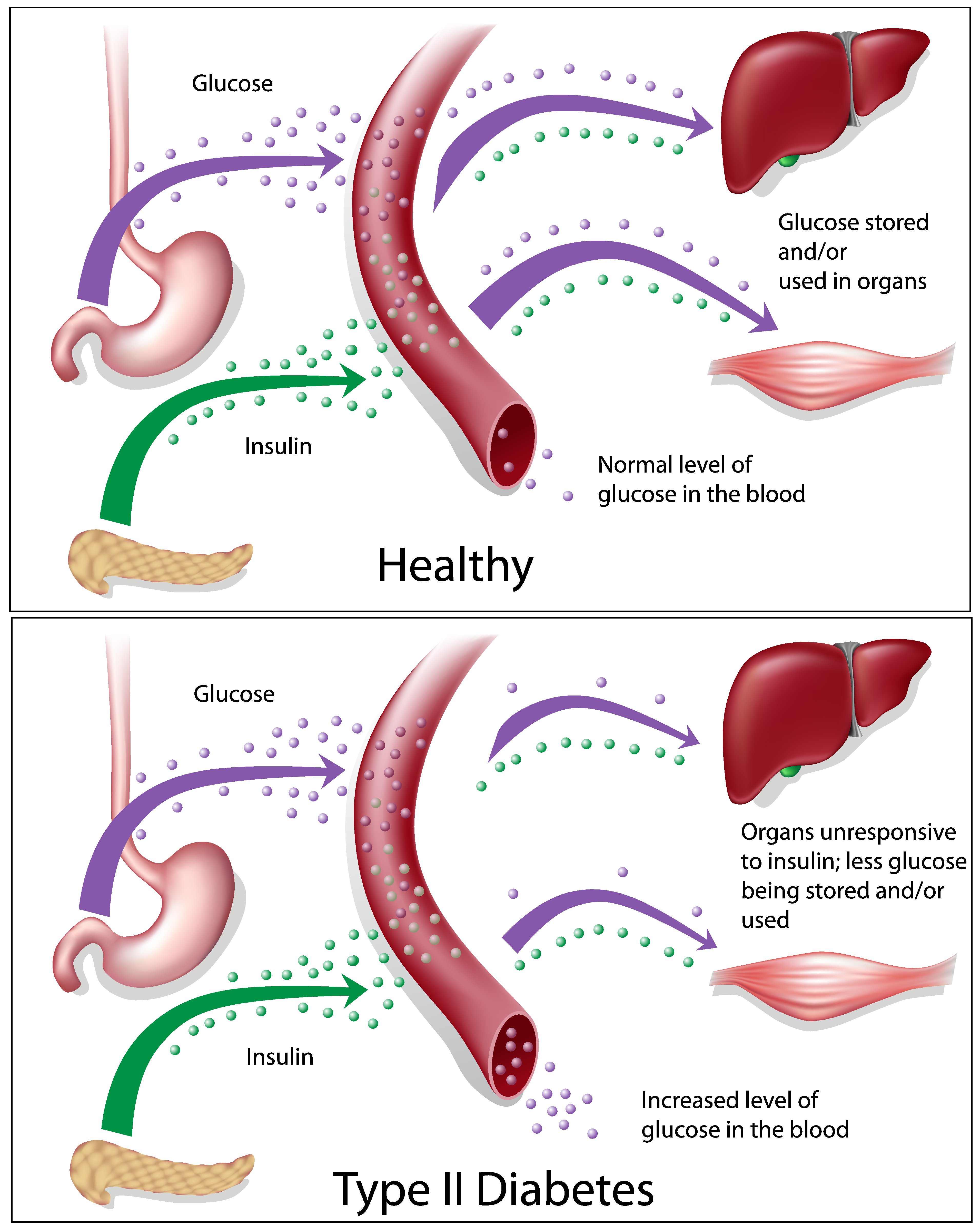 cure type 2 diabetes AllDayChemist Online Pharmacy Blog, Health Blog