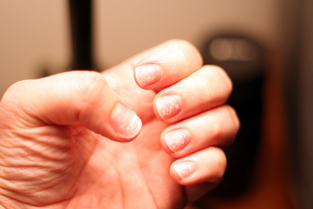 brittle nails – AllDayChemist Online Pharmacy Blog, Health Blog