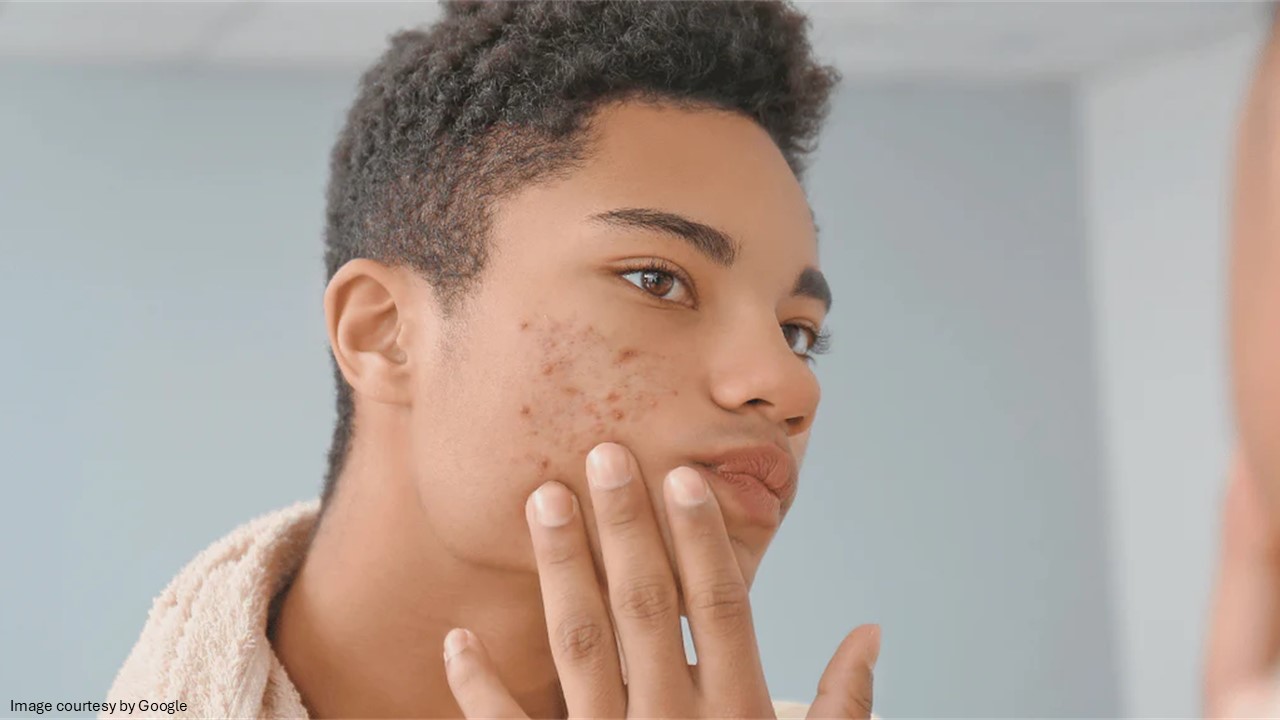 Dealing With Teen Acne