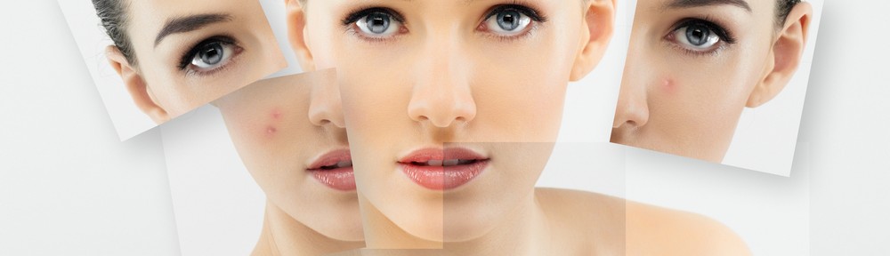 tips to deal with teen acne