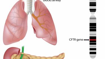 What you need to know about Cystic Fibrosis!