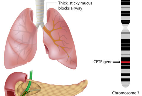 Cystic Fibrosis
