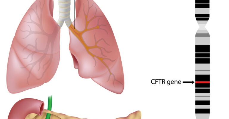 Cystic Fibrosis