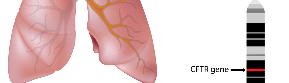 cystic fibrosis