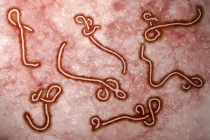 Ebola Virus Signs and Symptoms