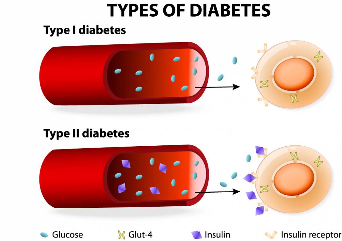Diabetes Levels – AllDayChemist Online Pharmacy Blog, Health Blog