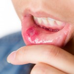 What is Pemphigus Vulgaris?