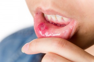 Pemphigus Vulgaris