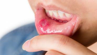 What is Pemphigus Vulgaris?