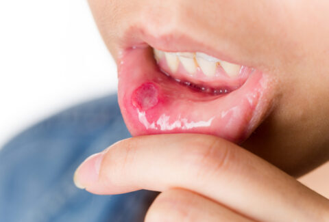 Pemphigus Vulgaris