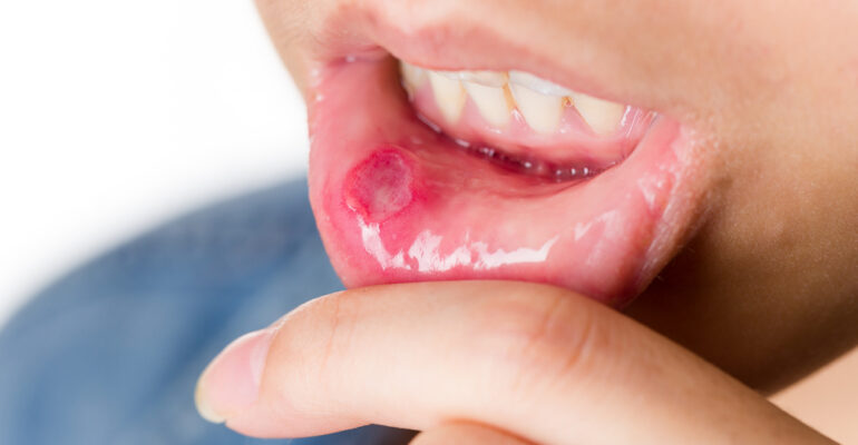 Pemphigus Vulgaris