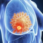 How to Prevent Breast Cancer?