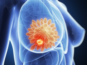 Prevent Breast Cancer