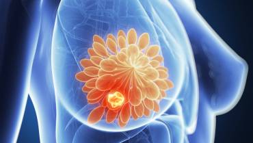 How to Prevent Breast Cancer?