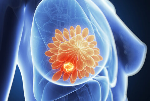 Prevent Breast Cancer