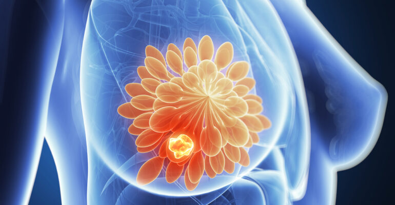 Prevent Breast Cancer