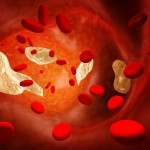 Thrombosis- Causes and Treatment