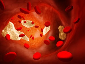 Thrombosis