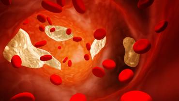 Thrombosis- Causes and Treatment