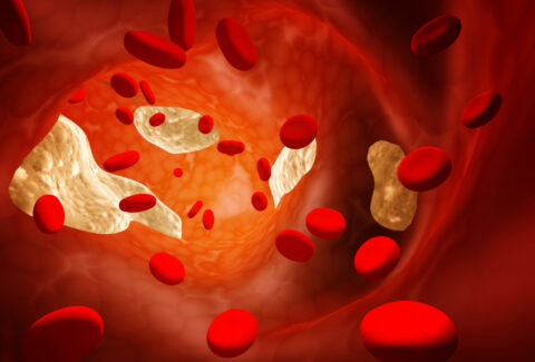 Thrombosis