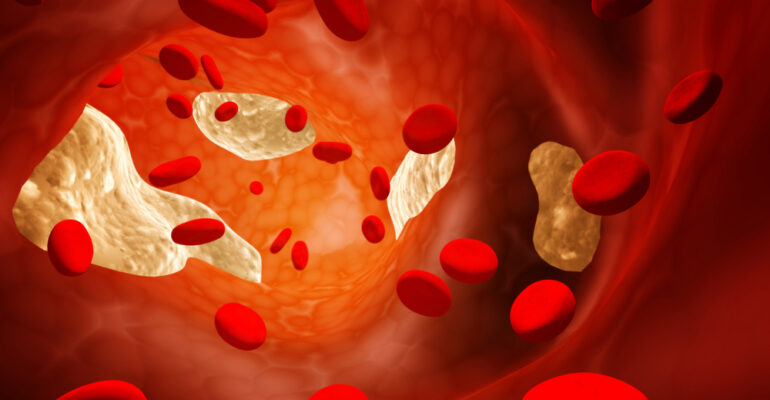 Thrombosis