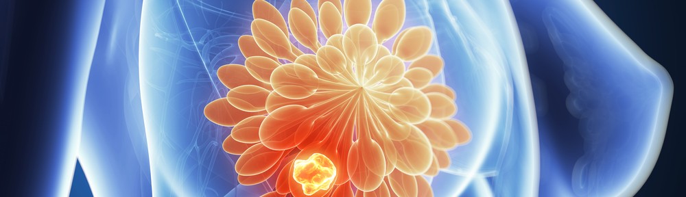 How to Prevent Breast Cancer?