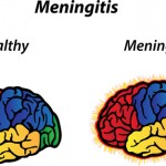 Meningitis: A Rare But Serious Condition