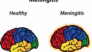 Meningitis: A Rare But Serious Condition