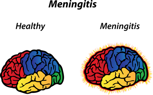 Meningitis: A Rare But Serious Condition