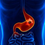 Tips to Prevent stomach ulcers