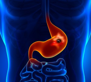 Tips to Prevent stomach ulcers
