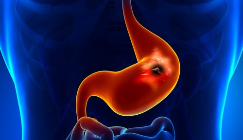 Tips to Prevent stomach ulcers