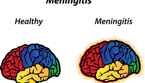 Meningitis: A Rare But Serious Condition