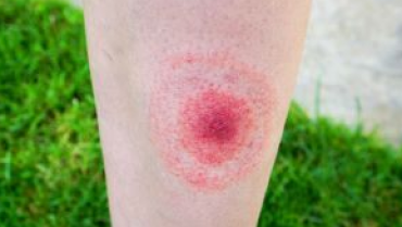 Don’t Let Ticks come Close to you, Prevent Lyme Disease