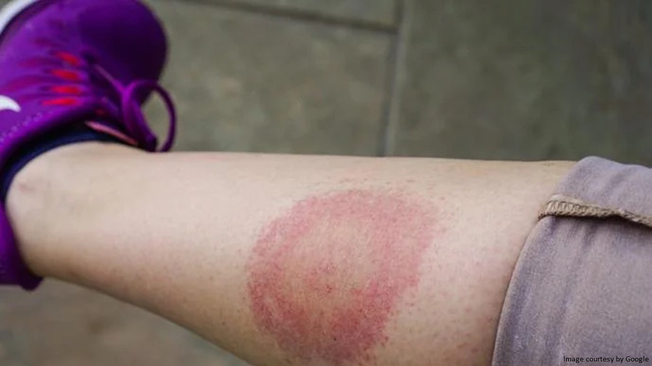 lyme disease rash