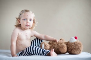Measles can Take Away your Child’s Life - AllDayChemist Health Blog