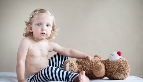 Measles can Take Away your Child’s Life - AllDayChemist Health Blog