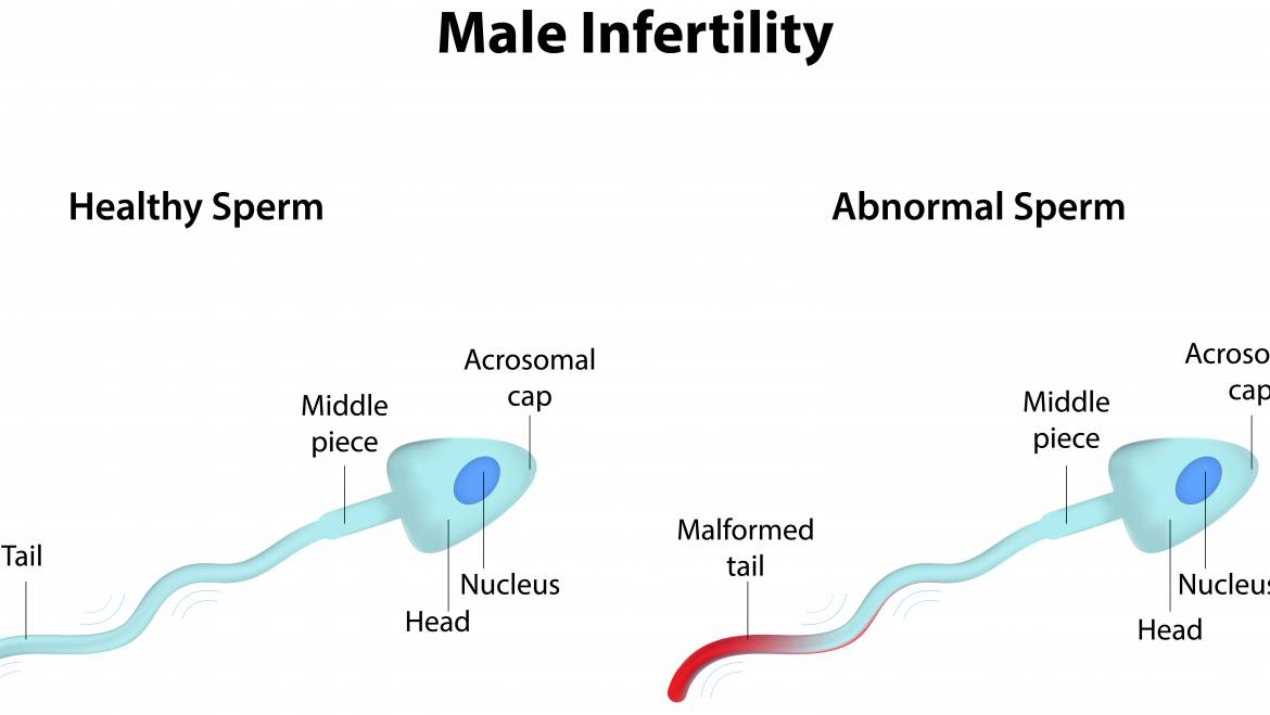 The Growing Problem Of Male Infertility