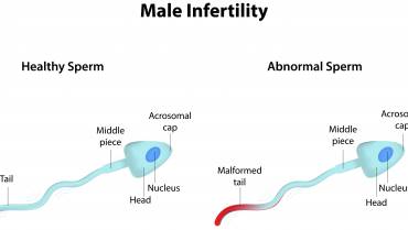 The Growing Problem Of Male Infertility