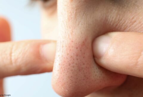 blackheads on nose - All Day Chemist
