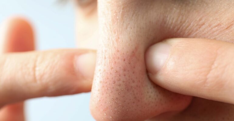 blackheads on nose - All Day Chemist