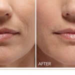 Everything you need to know about wrinkle fillers