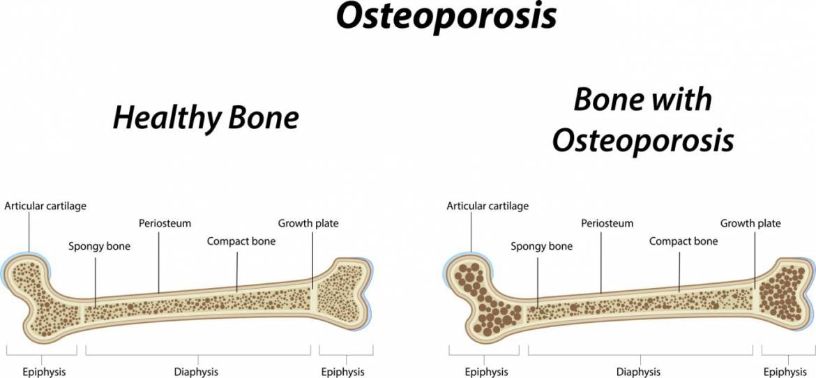 Osteoporosis.jpg