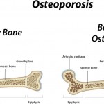 Osteoporosis and the Ways to Deal with It