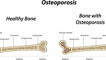 Osteoporosis and the Ways to Deal with It