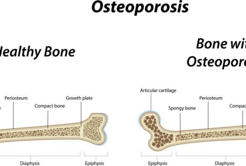 Osteoporosis
