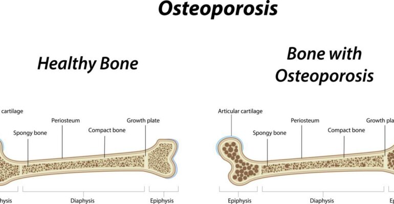 Osteoporosis